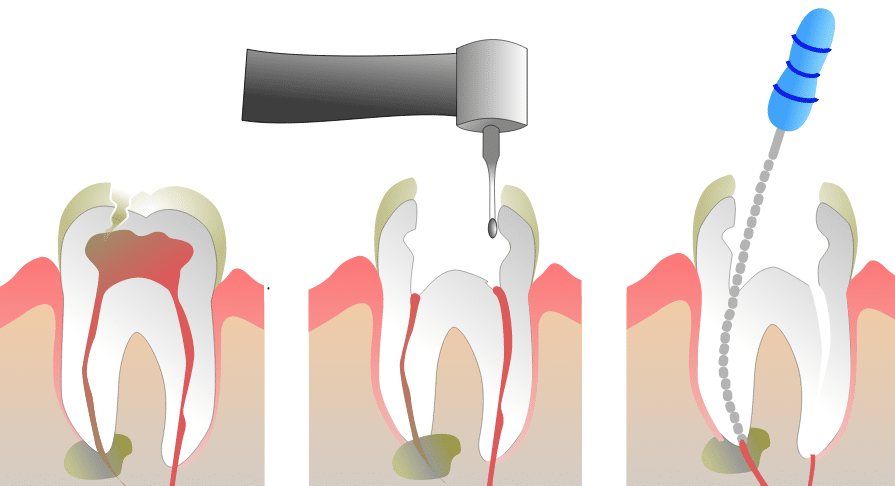 animated graphic of root canal procedure