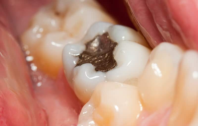 What is a Dental Overlay?