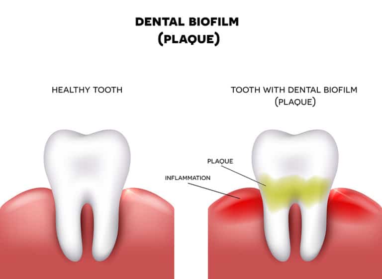 How to Remove Plaque Buildup on Your Teeth