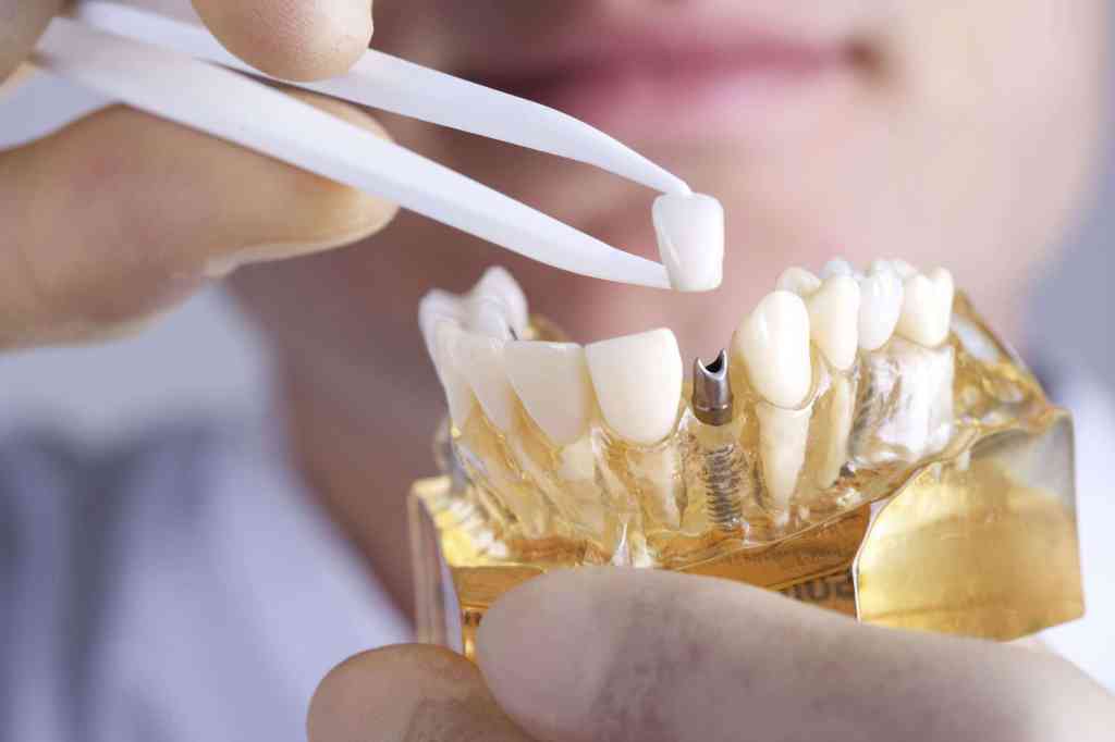 Do extracted teeth need to be replaced?